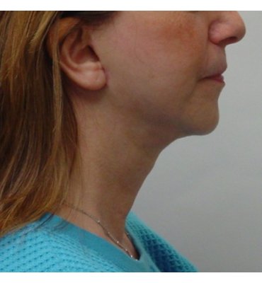 reduction of pudgy neck